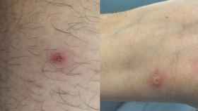 Las lesiones en la piel de un paciente.