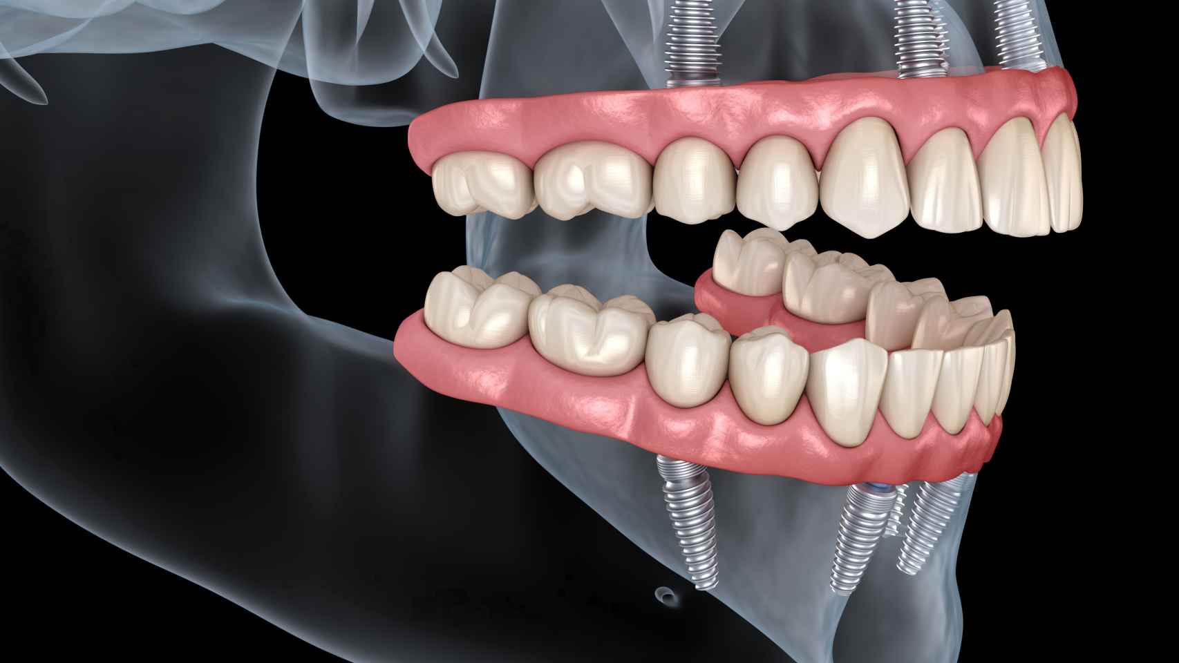 Arcada completa fija sobre cuatro implantes dentales, en el caso del All on Four.