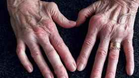Las manos de una mujer con artritis reumatoide.