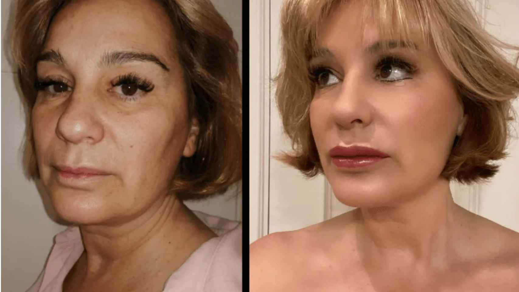 El antes y el después de Lola Sopeña tras el tratamiento Total Face.