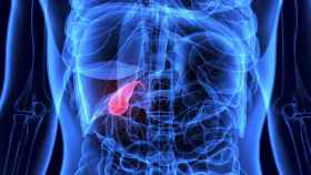 Si bien el cáncer de vesícula biliar tiene poca incidencia, su alta mortalidad lo convierte en un grave problema de salud.