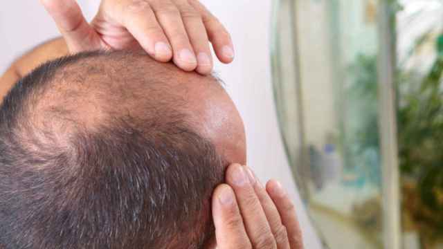El minoxidil y la finasterida son los dos tratamientos contra la alopecia masculina más usados.