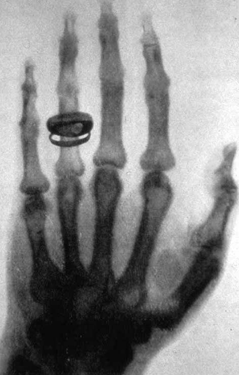 La mano de Anna, primera radiografía de la historia. https://es.wikipedia.org