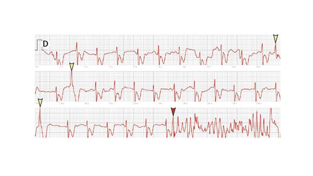 Electrocardiograma registrado por un smartwatch.