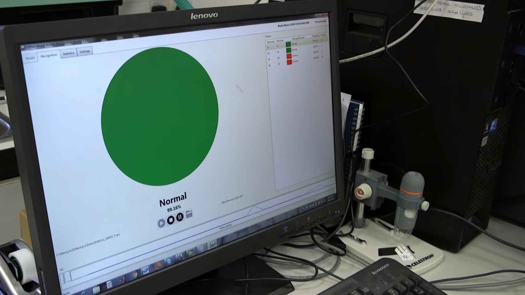 El iKnife conectado a una pantalla que muestra el resultado de la biopsia