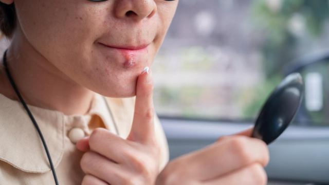 Remedios caseros para el herpes labial.