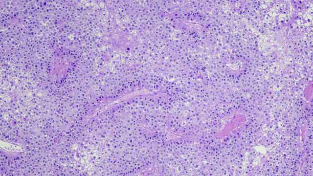 El carcinoma hepatocelular en microscopio.