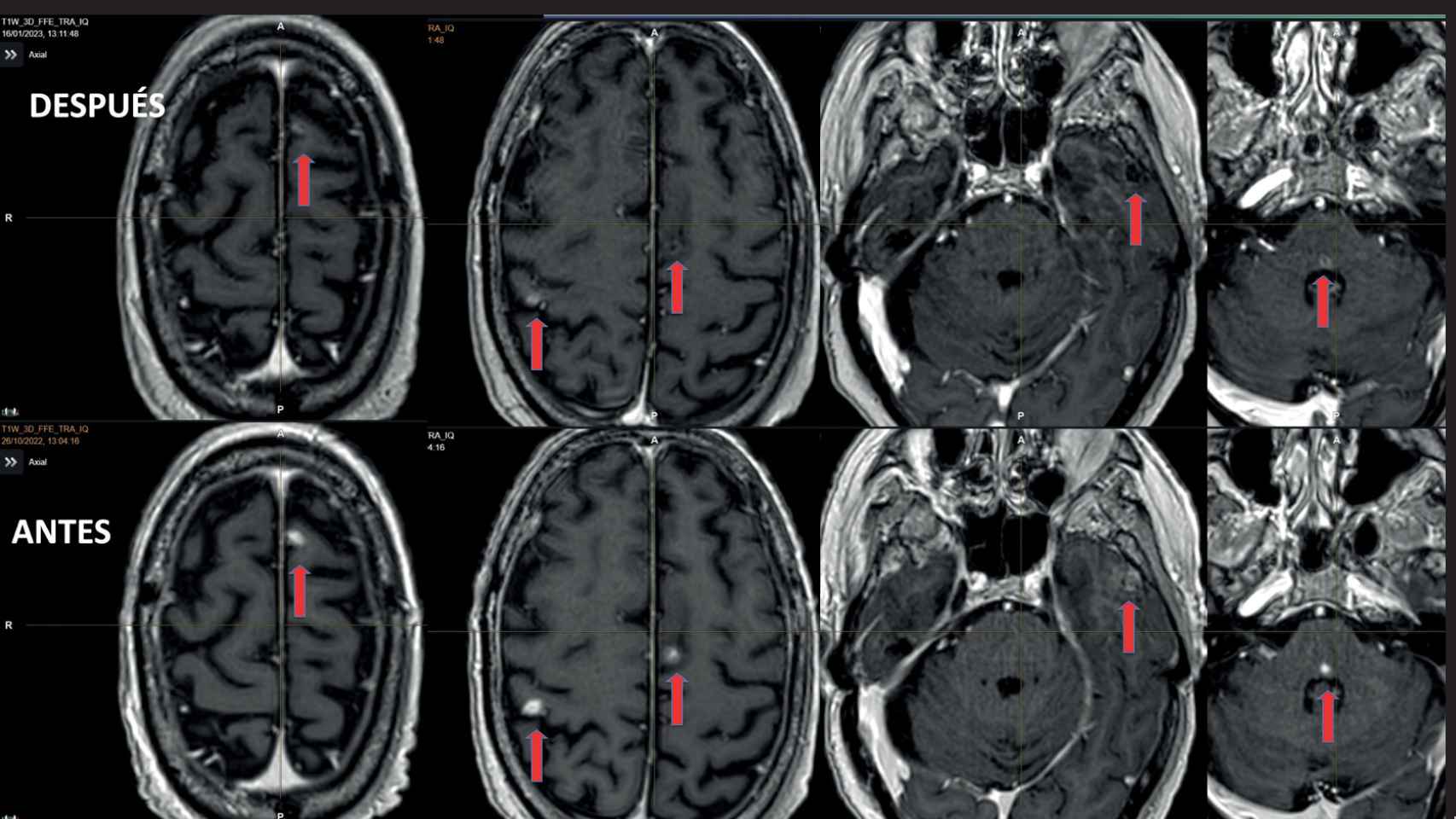 Antes y después del Tratamiento del varón de 66 años con metástasis cerebral.