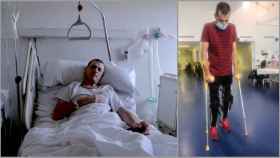 Sasha, el leñador ucraniano aplastado en plena guerra que ha vuelto a andar en Toledo