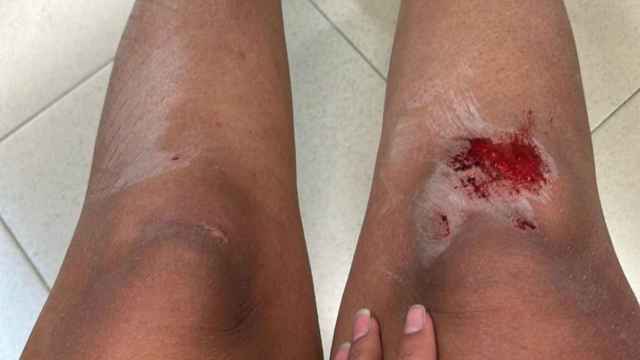 Heridas en las piernas de Adriana tras la agresión xenófoba en Alicante.