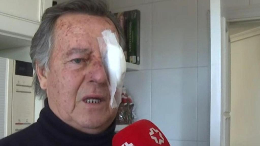 'Kuru' Villacieros con uno de sus ojos cubiertos tras ser agredido en su casa de Torrelodones.