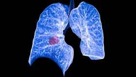 Evolución del cáncer de pulmón.