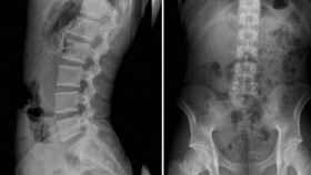 Radiografías de una hernia discal.