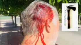El subinspector de la Policía Nacional tras recibir un hachazo en la cabeza por auxiliar a una mujer que había sufrido un robo.
