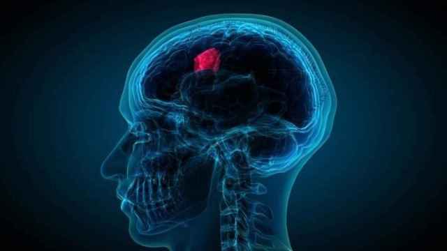 Localización del glioblastoma, el tumor cerebral más letal. Penn Medicine.