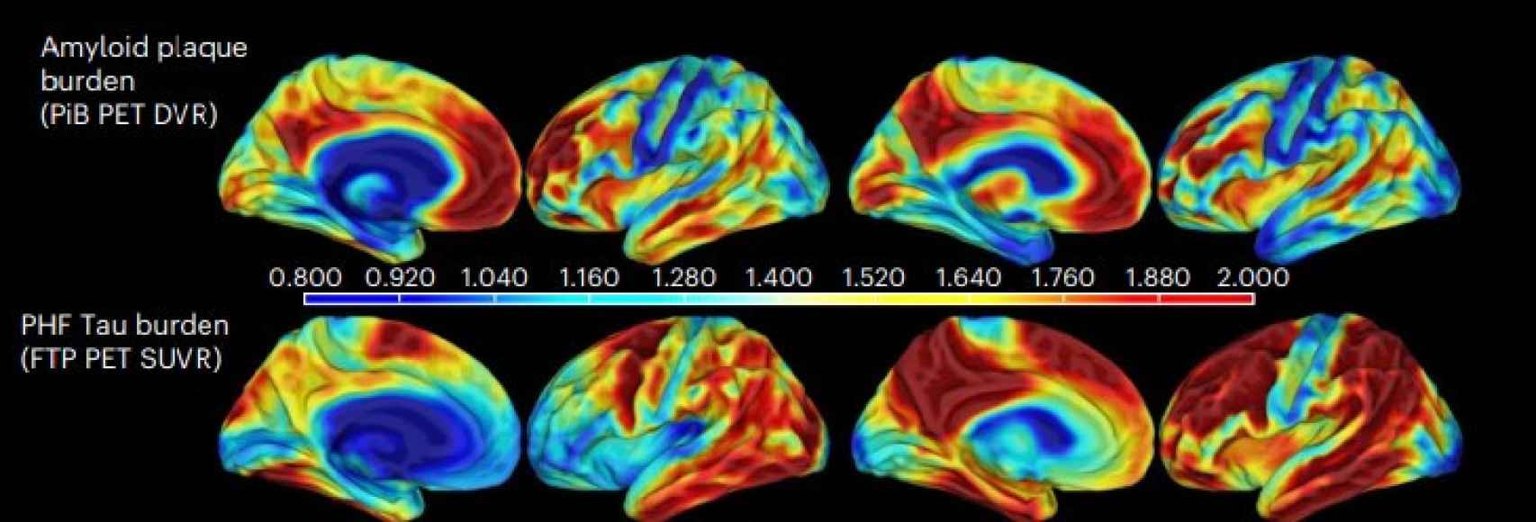 Un cerebro resiliente (izquierda) frente a uno con deterioro cognitivo. Concentraciones de amiloide (arriba) y tau (abajo).