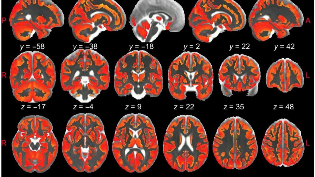 Inflamación cerebral.