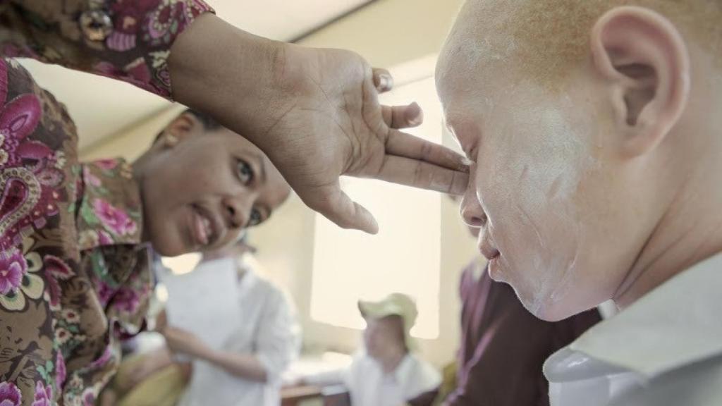 Una mujer pone protector solar a un menor albino en África.