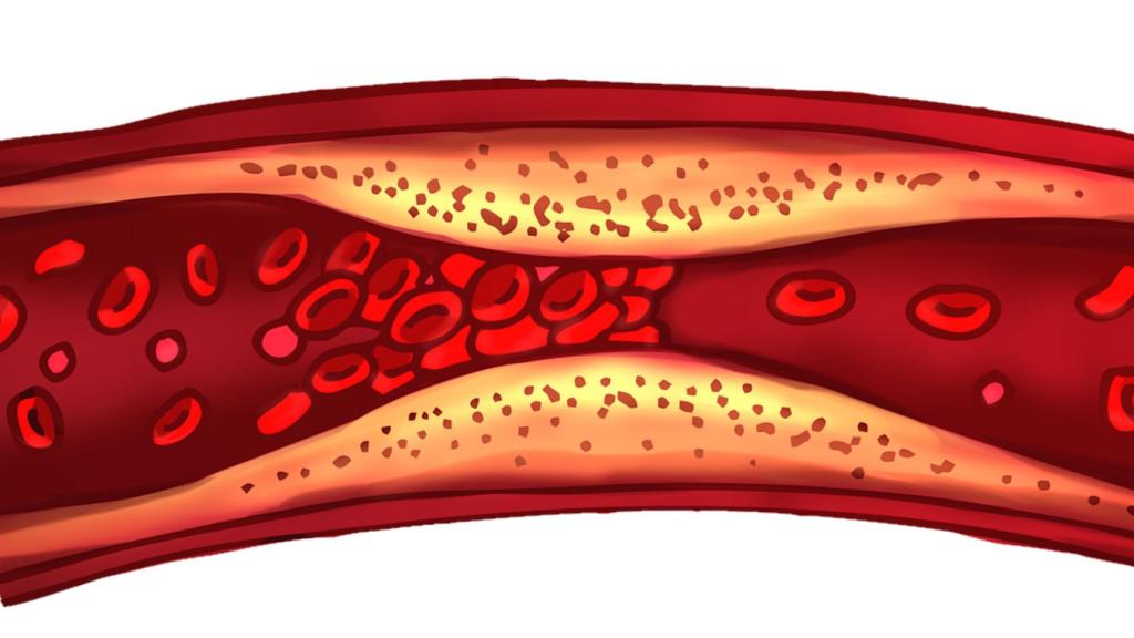 Representación de la ateroesclerosis