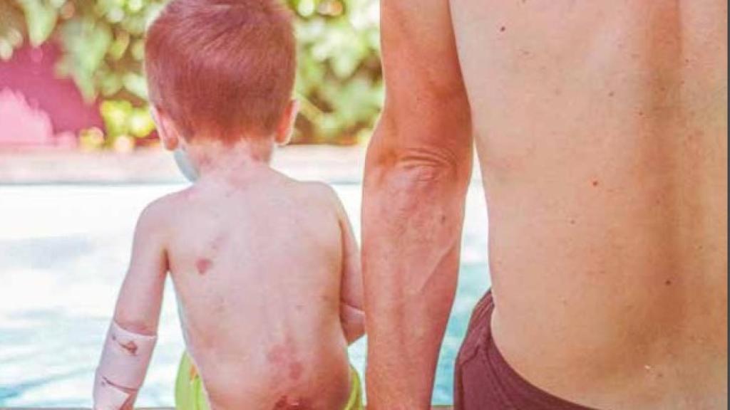 Un niño pequeño, de espaldas en una piscina, que sufre Epidermólisis Bullosa.