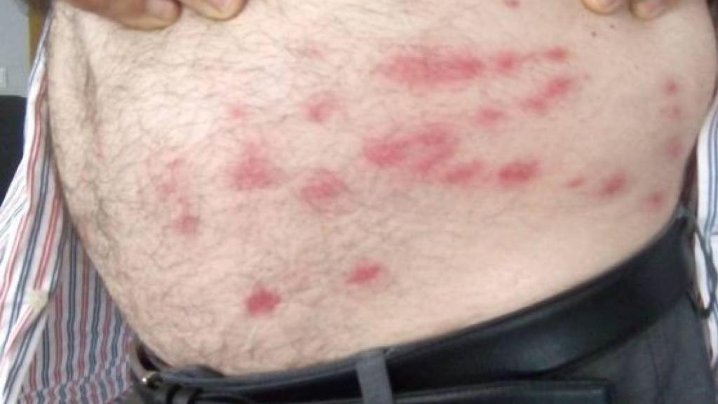 Ejemplos de picaduras de mosca negra sobre el abdomen de un hombre