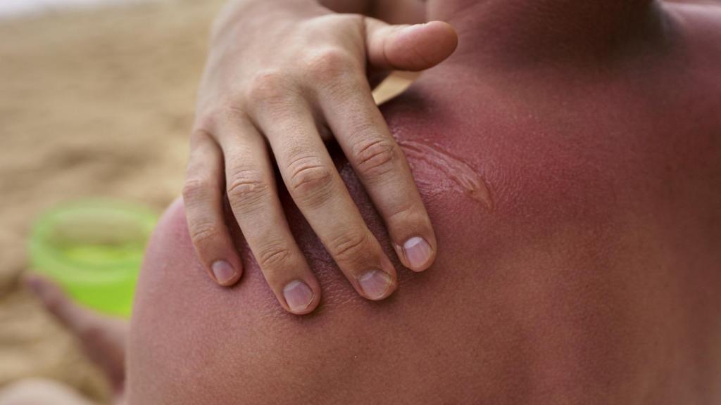 Un hombre aplicando crema sobre una piel quemada por el sol.