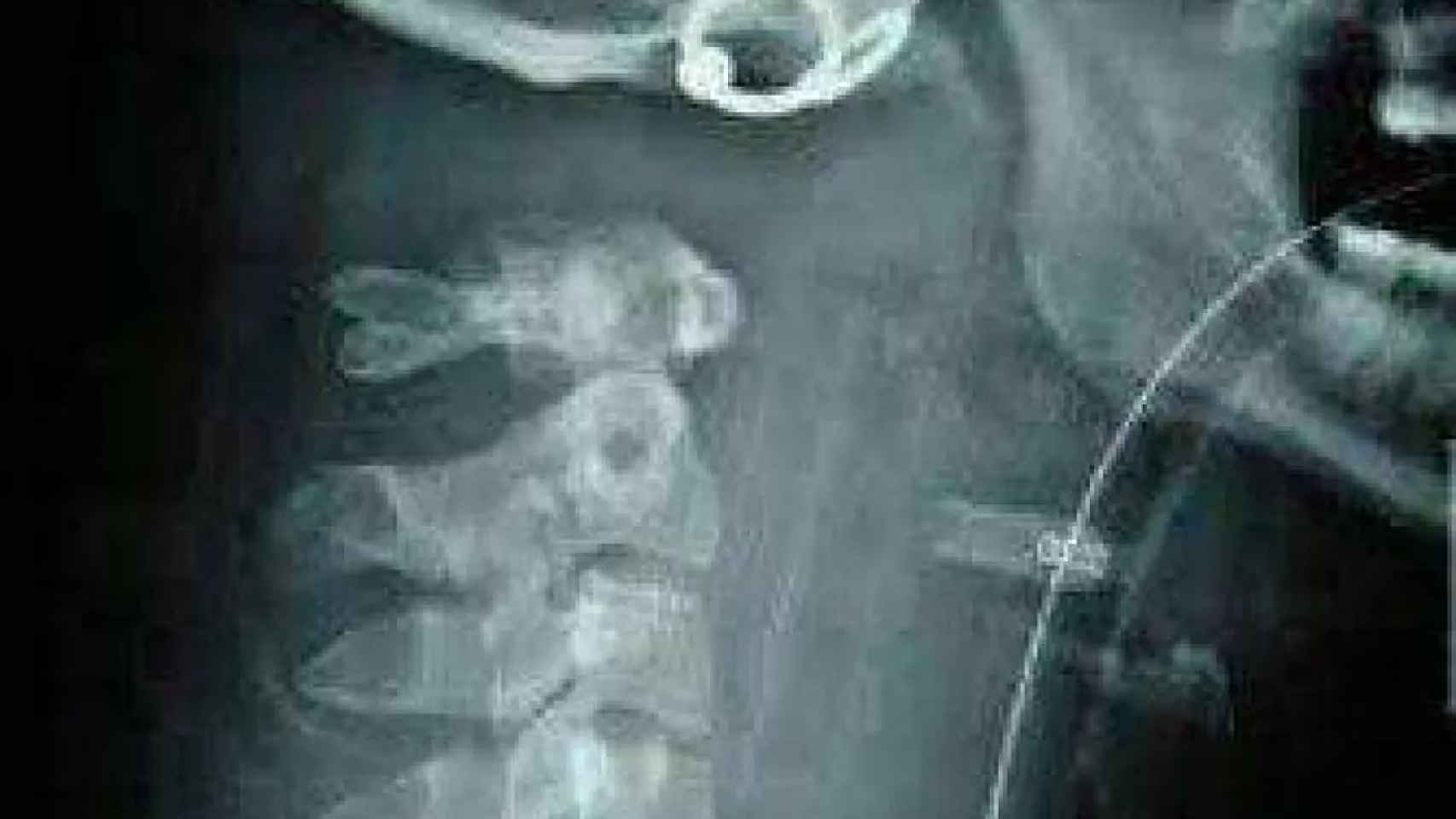 Radiografía del cuello del niño.