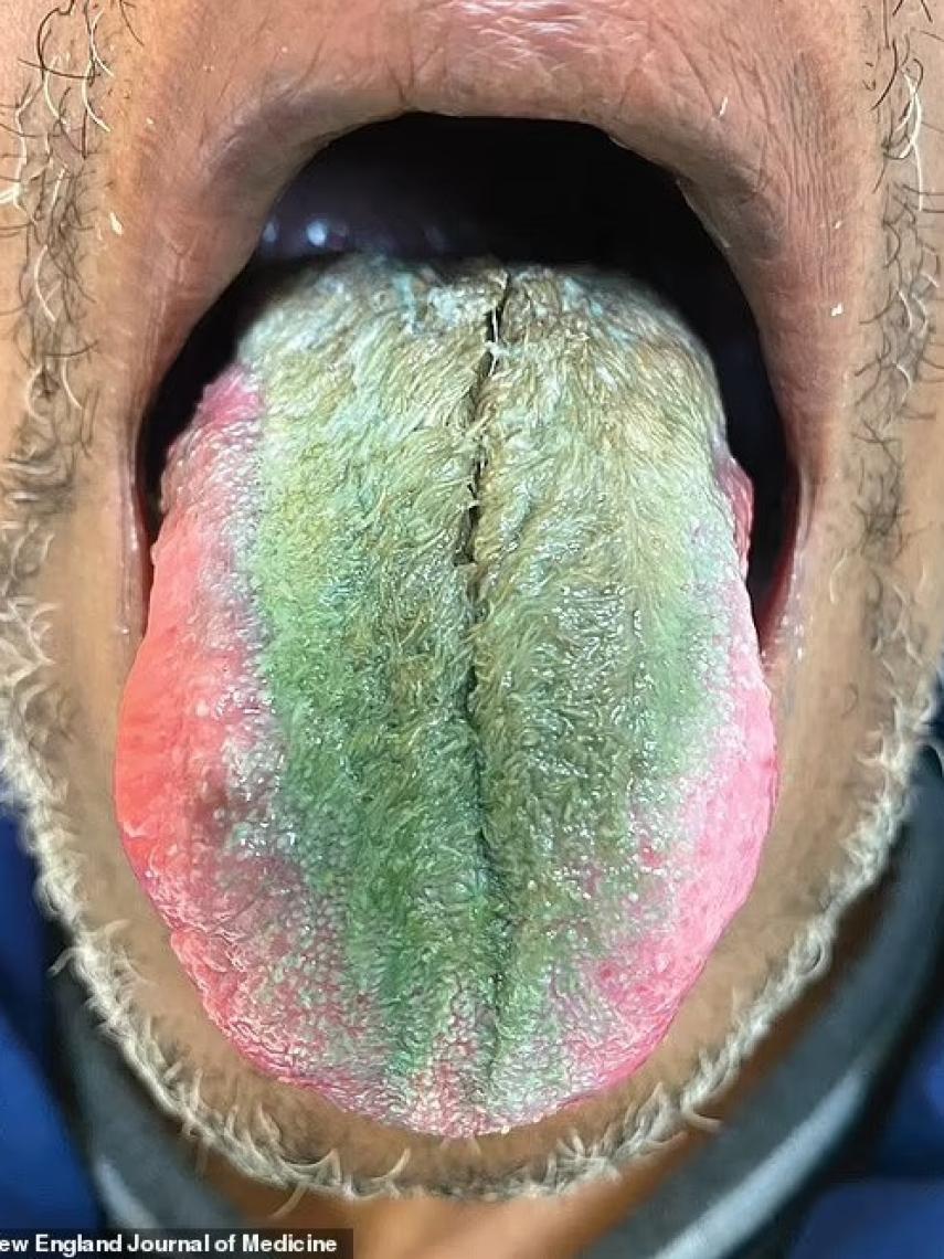 La lengua del hombre afectado con el síndrome de la lengua peluda.