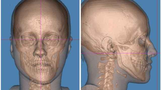 Estudio 3D de cirugía ortognática. Hospital Ruber Internacional.