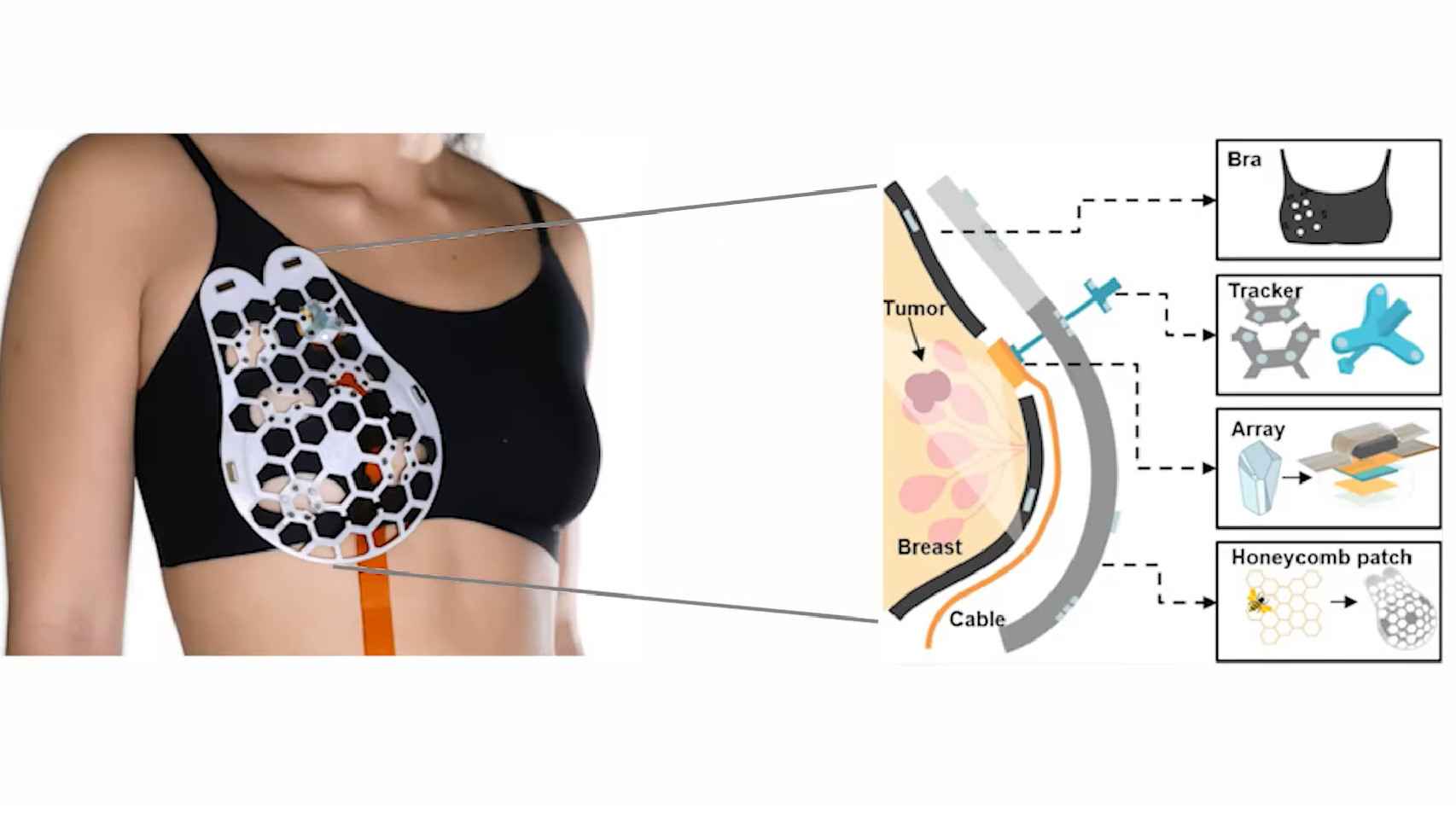 Diagrama del dispositivo para detectar el cáncer de mama