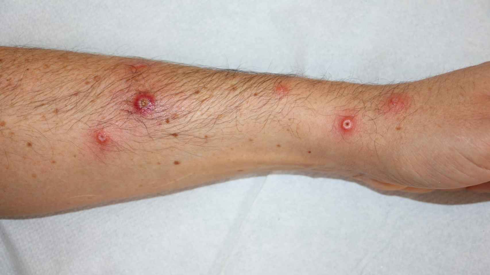 Lesiones en el brazo de un paciente del estudio.