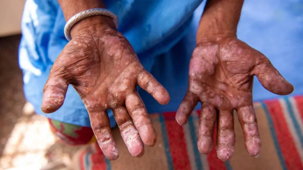 La lepra es una enfermedad infecciosa crónica provocada por el bacilo 'Mycobacterium leprae'.