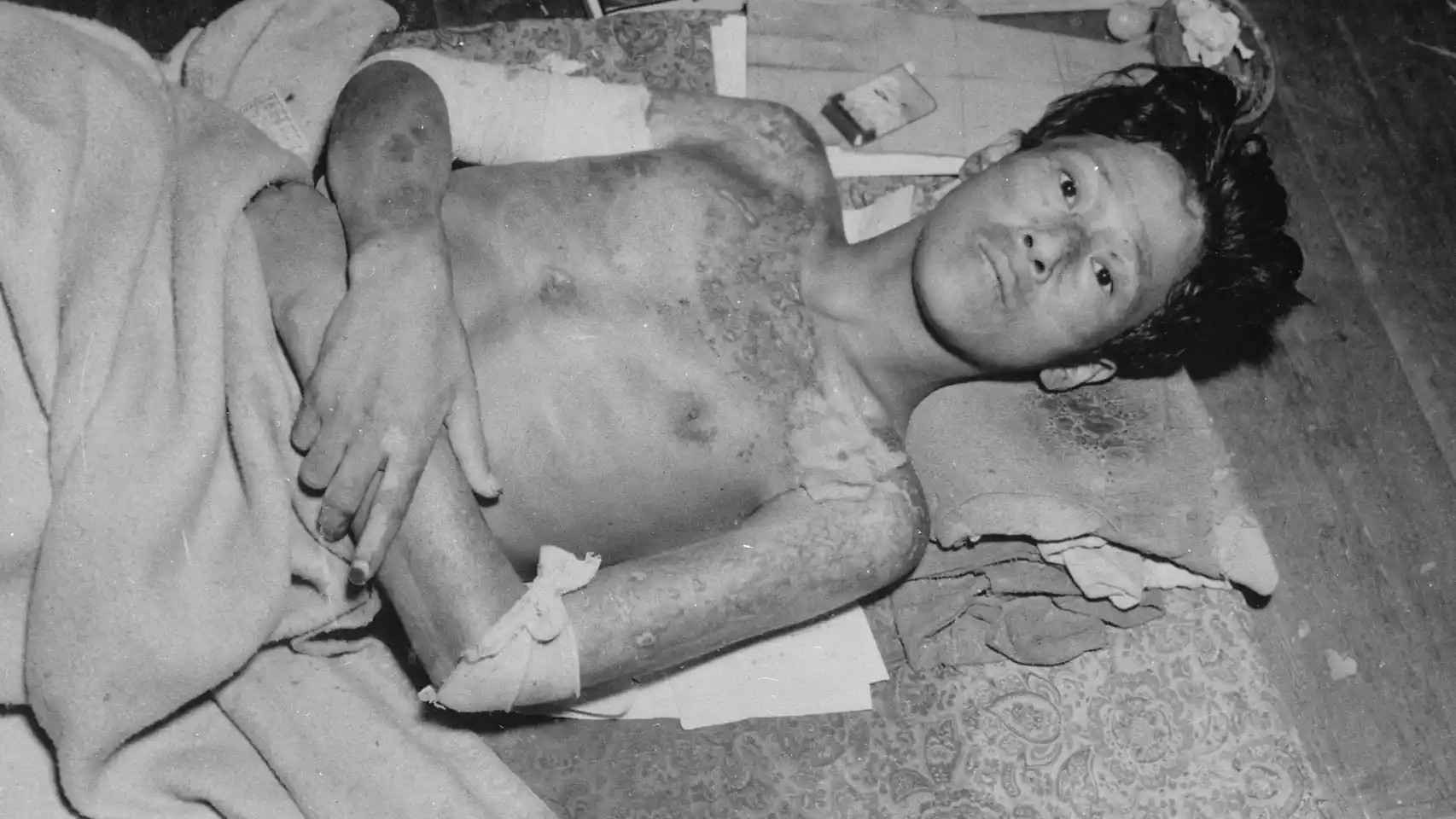 Un hombre herido tras la bomba atómica de Nagasaki siendo tratado por el personal sanitario. Foto: Reuters