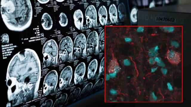 Las neuronas senescentes ocupan las áreas blanca, azul y roja del cerebro. Nature Medicine.
