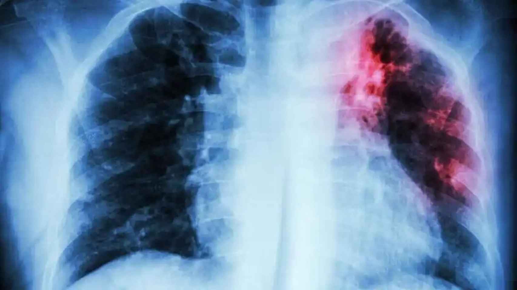 Radiografía que muestra un pulmón con cáncer