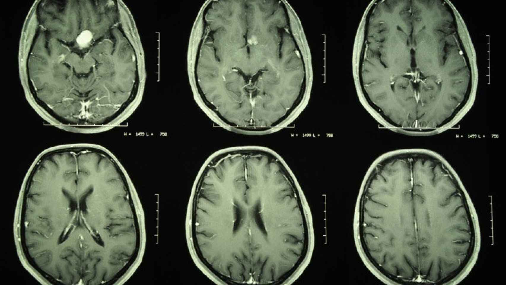 Imágenes computerizadas de un tumor cerebral