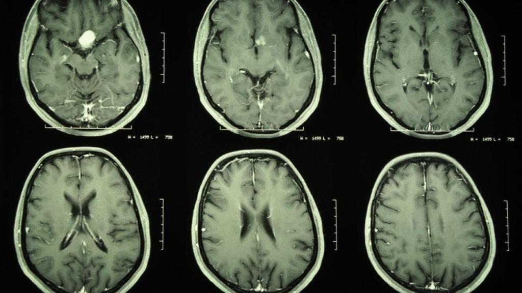 Tumor cerebral.