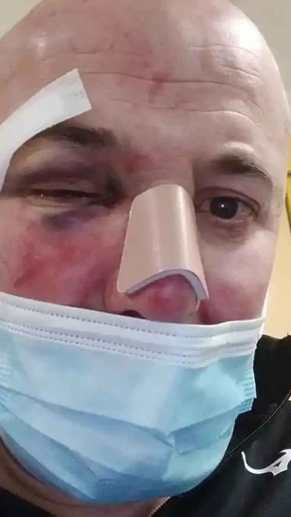 Una foto de Carlos con las lesiones que sufrió en la cara tras la paliza a manos supuestamente de dos policías nacionales.