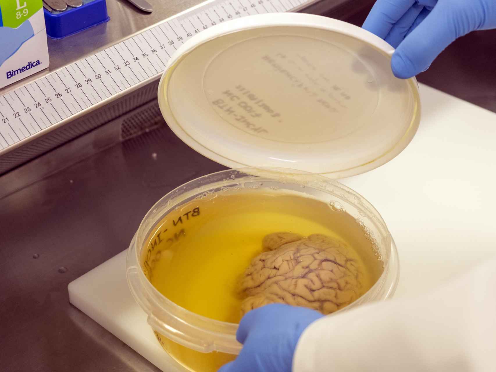 Cerebro conservado en formol en el banco de cerebros.