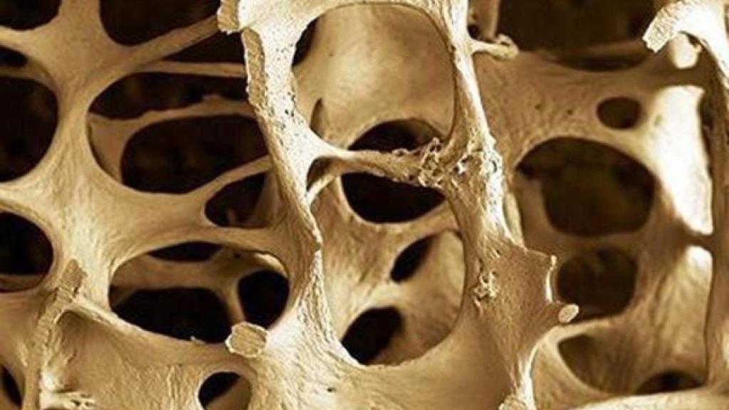 Osteoporosis