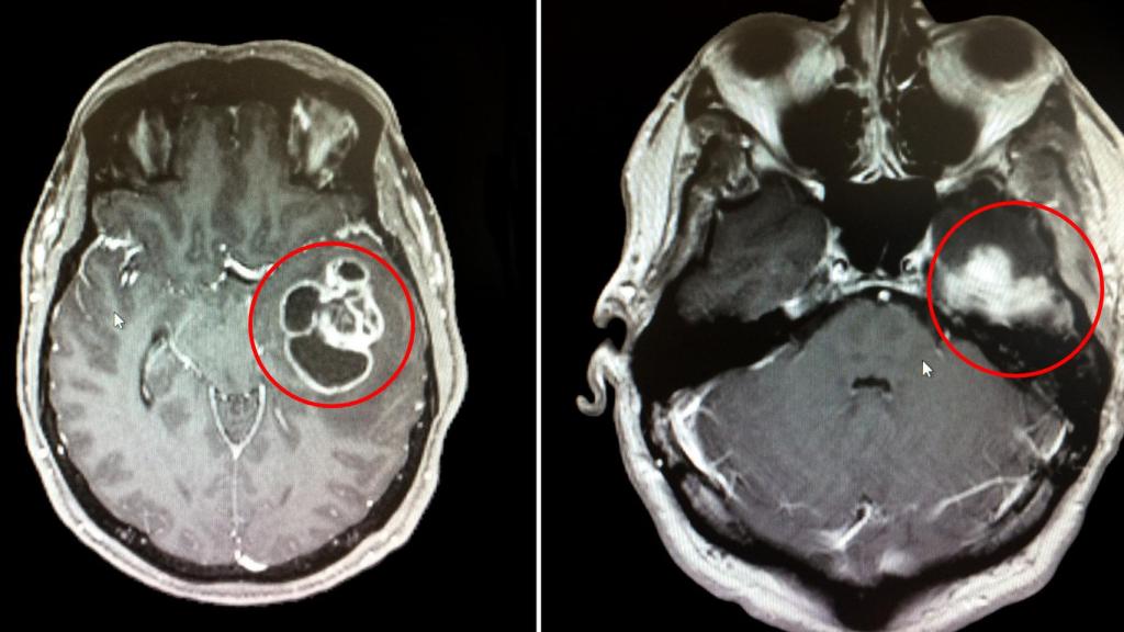 Glioblastoma.