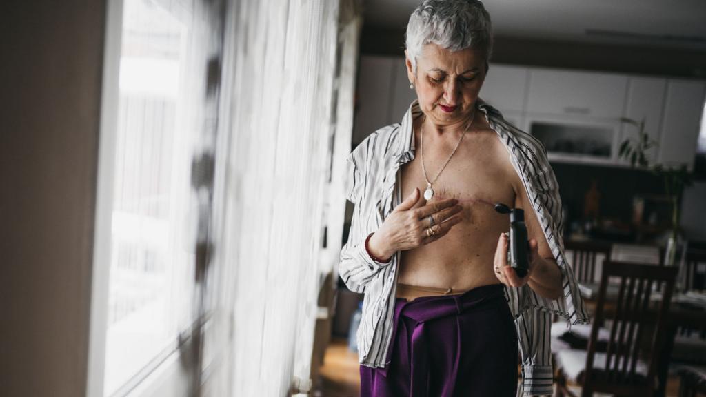 Imagen de archivo de una mujer tras una masectomía. Nikola Stojadinovic iStock