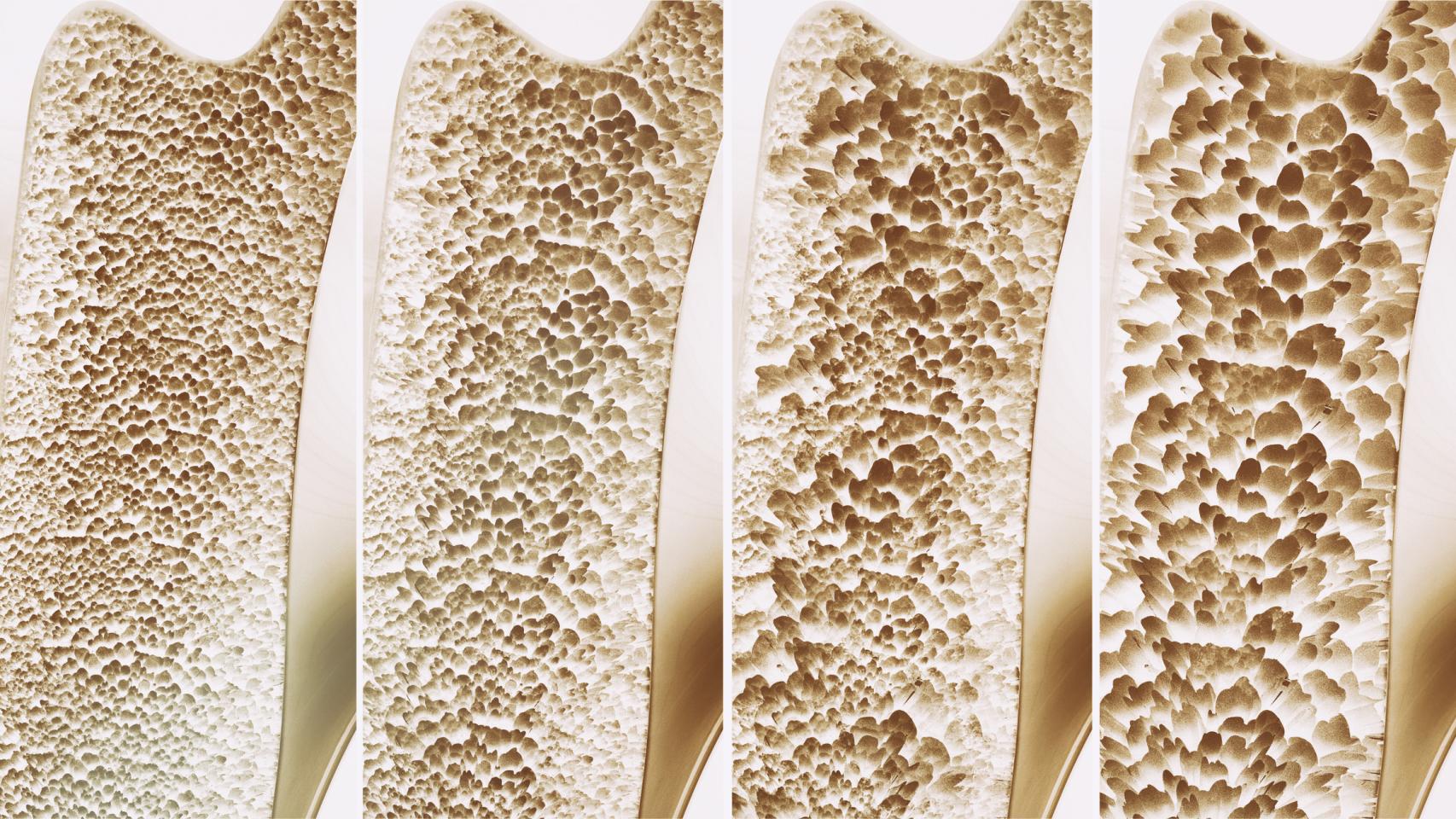 Evolución de la osteoporosis.