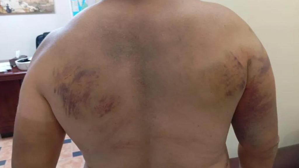 Heridas provocadas por los colonas a un palestino