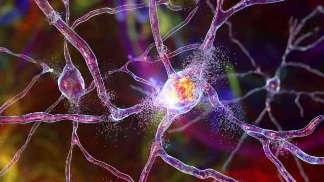 Ilustración conceptual en 3D  de destrucción de neuronas.