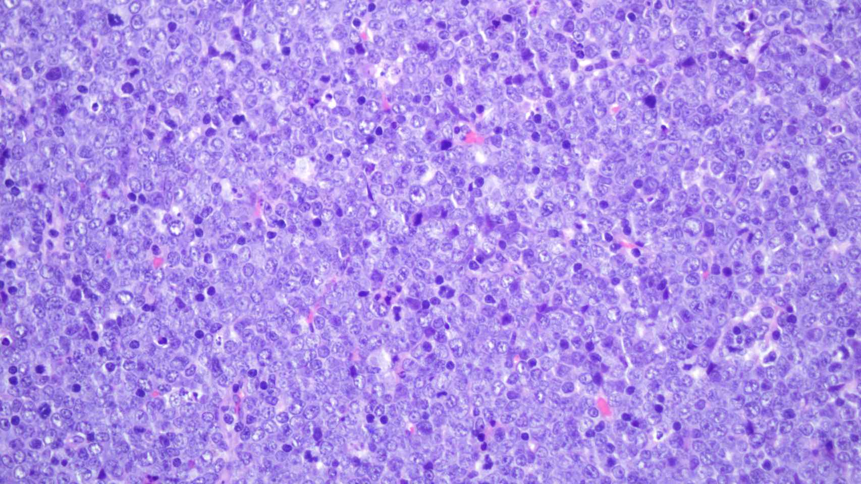Histología de un nódulo linfático de un ratón con leucemia linfoblástica aguda
