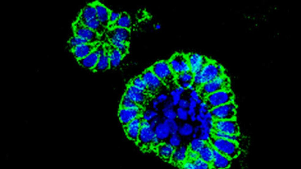 Organoide de cáncer de colon