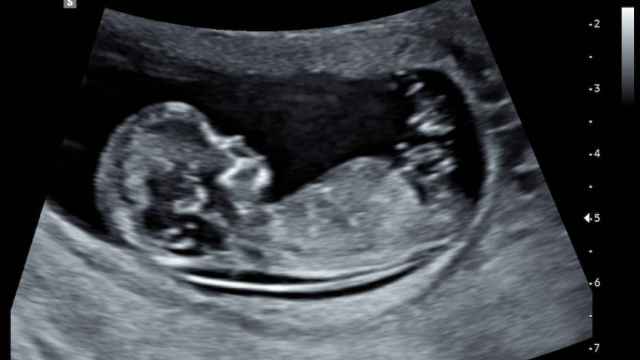 Una ecografía prenatal.