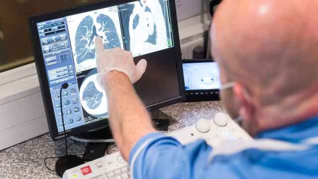 Sanidad deja en el limbo el mayor cambio de paradigma en 30 años en el cáncer de pulmón