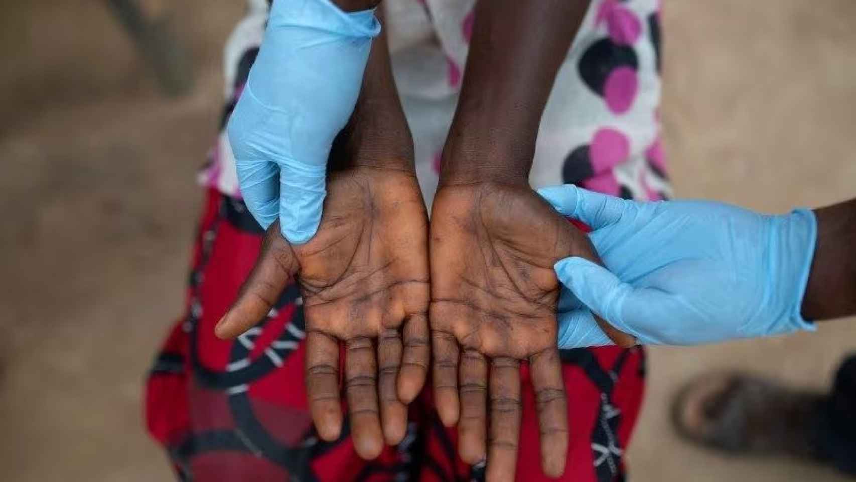 Lesiones en las manos de una paciente con Mpox.